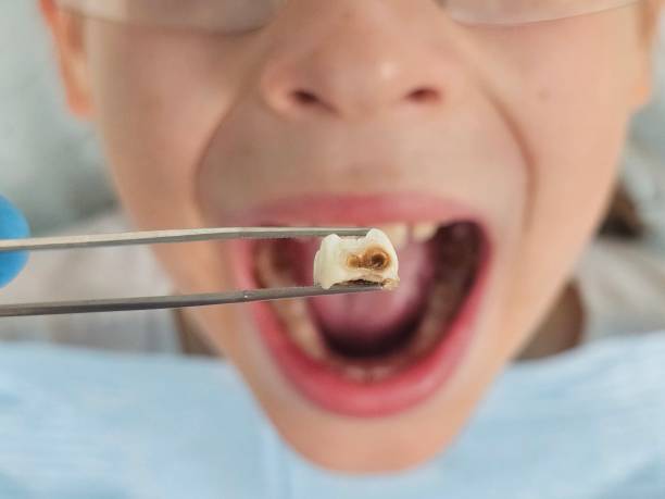 Best Urgent Care for Lost Fillings or Crowns in Greenville, AL