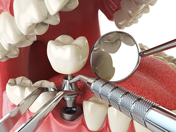 Best Emergency Dental Care for Broken or Chipped Teeth in Greenville, AL